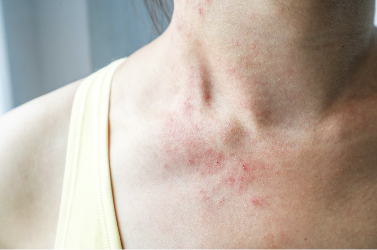 magnetisme pour l'eczema à nantes