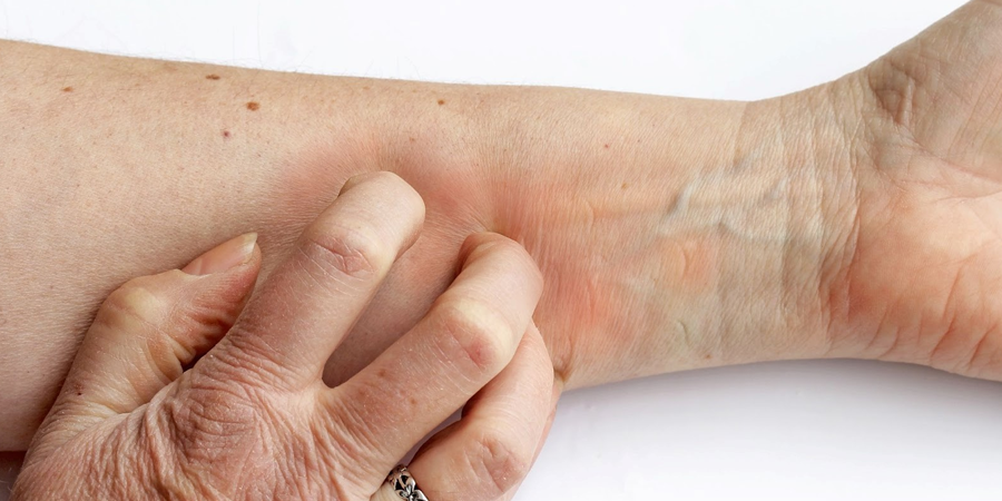 démangeaison peau eczéma